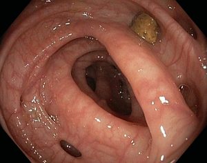 Endoscopy, Gastroscopy & Colonoscopy Procedures Sydney | Safe Surgery