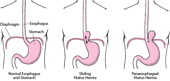 Diet After Hiatal Hernia Surgery Australia