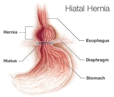 Hiatal Hernia Surgery: Recovery, Scars, and More